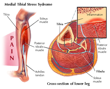 http://www.srcpt.com/blog/category/shin-splints-posterior-tibial-tendinitis